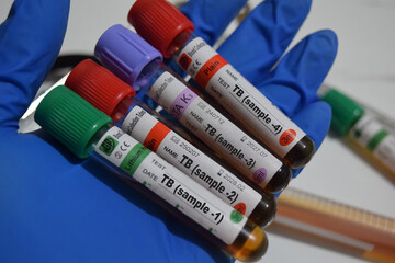 TB sample 1,2,3,4 - Test with blood sample. Top view isolated on office desk. Healthcare or Medical concept