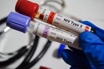 HIV Type1 - Test and HIV Type2 with blood sample. Top view isolated on office desk. Healthcare or Medical concept