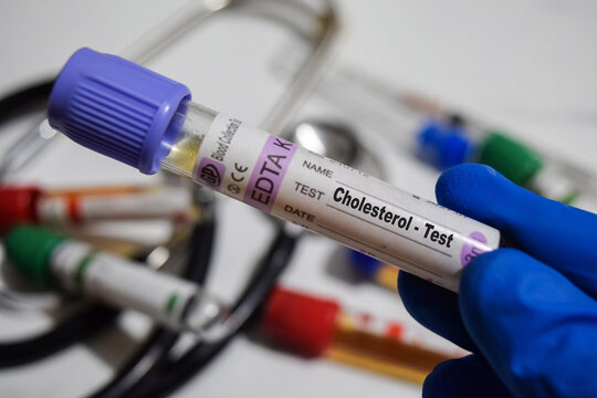 Cholesterol - Test with blood sample. Top view isolated on office desk. Healthcare or Medical concept