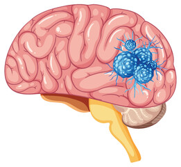 Human Brain with Tumor Vector Illustration