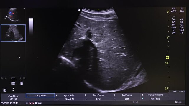 Ultrasound Scan Display on Medical Monitor, Detailed Internal Organ Imaging Scene