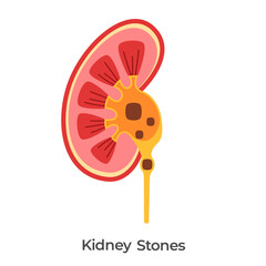 Kidney stones kidneys problem stone clogging urinary anatomy drawing illustration