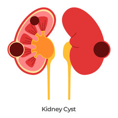Kidney cyst renal cysts illustration anatomy drawing of fluid filled sacs in kidneys