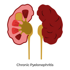 Kidney Pyelonephritis kidneys bacterial infection anatomy drawing illustration