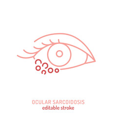 Ocular sarcoidosis icon. Editable vector illustration of granulomatous inflammation in the eye.