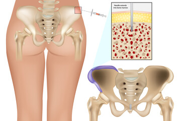 Bone Marrow Aspiration Procedure from Posterior Iliac Crest. Medical Illustration of Bone Marrow Biopsy Site in Pelvic Bone. Bone Marrow Extraction Technique