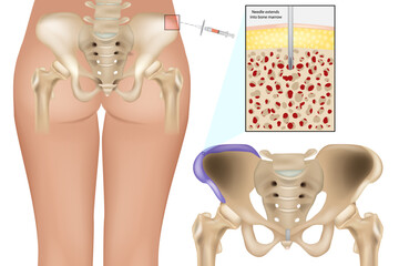 Bone Marrow Aspiration Procedure from Posterior Iliac Crest. Medical Illustration of Bone Marrow Biopsy Site in Pelvic Bone. Bone Marrow Extraction Technique