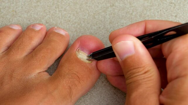 Removing an injured nail on the little finger with tweezers. Removed old fallen off nail big toe nail after mechanical injury damage under the nail, subnail