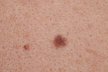 Woman with moles on her body, closeup