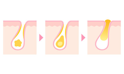 角栓の詰まった毛穴　断面図