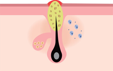 Cross Section of Inflamed Acne with Pus (Yellowhead / Pustule)