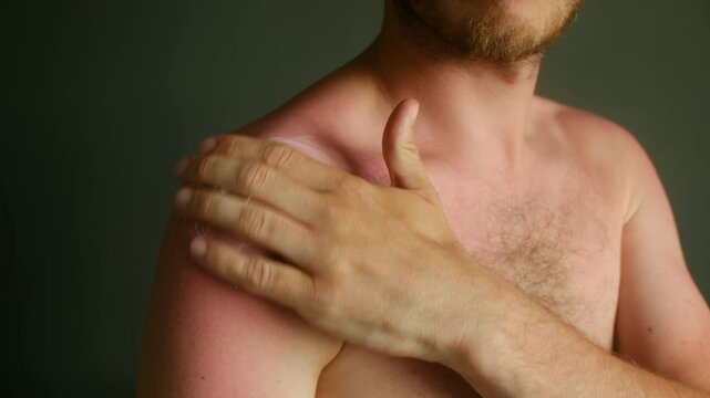 Shirtless man gently applying a white cream to his sunburned and red shoulder, providing relief from the painful effects of excessive sun exposure. Man applying soothing cream on sunburned shoulder