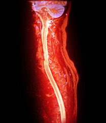 The MRI scan of the cervical spine shows detailed imaging of the vertebrae and spinal cord, highlighted in vibrant pink. The clear delineation of the spinal cord and vertebral structures is evident.