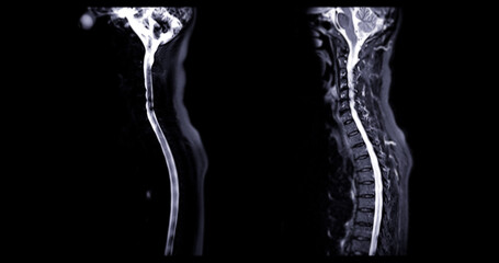 The MRI scan of the cervical spine shows detailed imaging of the vertebrae and spinal cord, highlighted in vibrant pink. The clear delineation of the spinal cord and vertebral structures is evident.