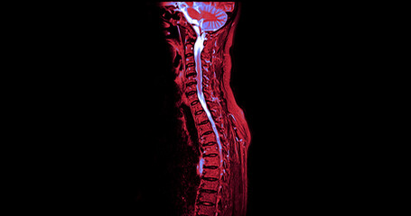 The MRI scan of the cervical spine shows detailed imaging of the vertebrae and spinal cord, highlighted in vibrant pink. The clear delineation of the spinal cord and vertebral structures is evident.