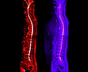 MRI whole spine screening for diagnosis spinal cord compression.
