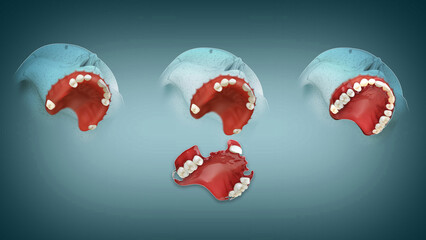 Removable Partial Denture for the upper jaw. New age 3D dental image for better understanding. © KOUSHIK CHATTERJEE