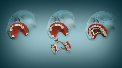 Partial Denture (removable) for upper jaw(Before and After). Medically approved and accurate image. © KOUSHIK CHATTERJEE