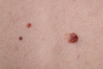 Woman with moles on her body, closeup