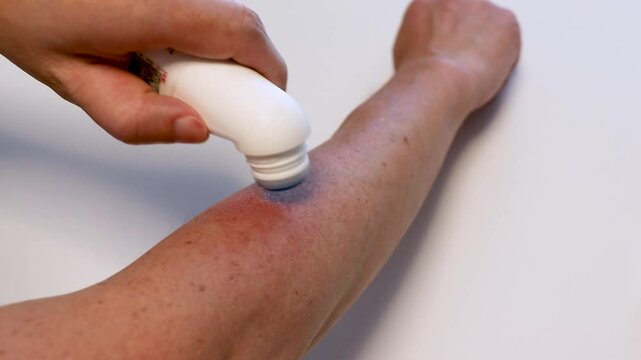 虫刺されの跡にかゆみ止めの薬を塗る