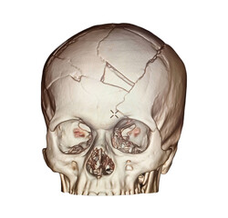 3d reconstruction computer tomography or CT scan image showing severe fracture of the face after an accident. Teeth and mandible fracture.
