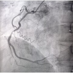 Coronary angiogram of right coronary artery during cardiac catheterization with dye. Findings...