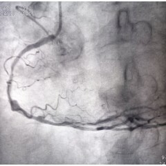 Coronary angiogram of right coronary artery during cardiac catheterization with dye. Findings...