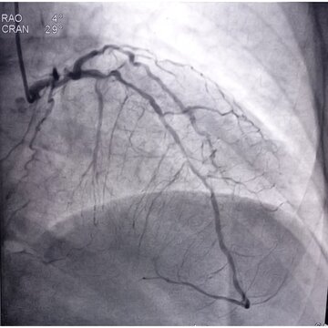 Coronary angiogram of left coronary artery during cardiac catheterization with contrast dye. Abnormal findings. Colour adjust