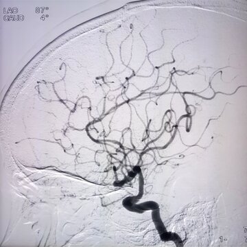 Digital Subtraction Angiography (DSA) or Cerebral angiography of brain, a technique used to visualize blood vessels in the brain during procedures like angioplasty and stenting. Digital arteriogram.
