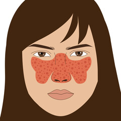 Butterfly autoimmune symptoms of SLE on the nose and cheeks of long hair woman, illustration on white background