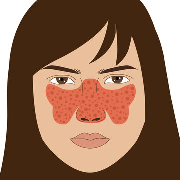 Butterfly autoimmune symptoms of SLE on the nose and cheeks of long hair woman, illustration on white background