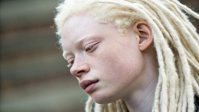 Close Up Albino African American With Pale Dreadlocks and Skin Representing Genetic Uniqueness Suitable for Diversity Topics