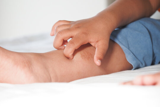 Child scratching an itchy leg in a bright room