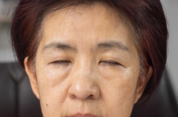 Senior asian woman is periorbital eye fatigue.
