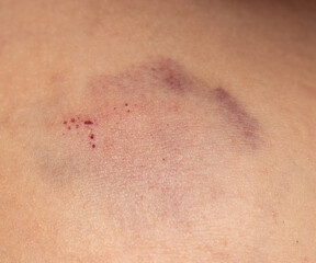 blue bruise on the skin of the arm.