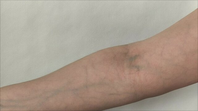Varicose veins on the hands of a woman in close-up. Venous diseases. Cardiovascular diseases.