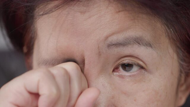 Senior asian woman is periorbital eye fatigue.