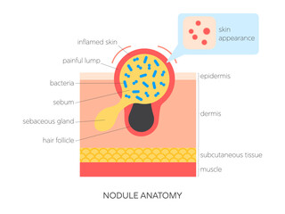 Nodule anatomy flat vector illustration. Medical infographic showing skin structure, sebum buildup, inflammation and surface view. Skincare and dermatology concept.