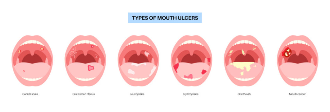 Types of mouth ulcer