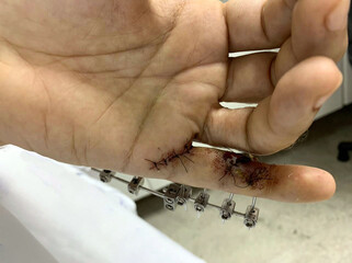 External fixator in the hand, a medical device used to immobilize and stabilize bone fractures,...