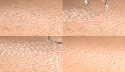 Old wrinkled skin surface laser resurfacing macro procedure