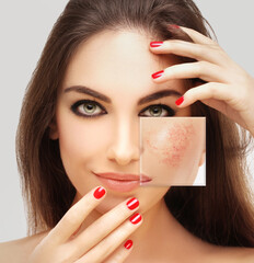 Rosacea ,facial redness.Before and after	