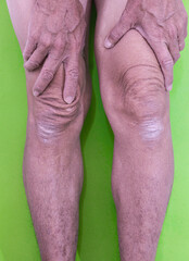 body parts Calluses and rough skin on legs and knees. of the elderly with muscle inflammation and bone degene.