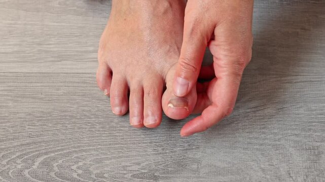 Toenail with fungal infection or damage, close up of nail health problems, nail fungus, doctor examining diseased toenails