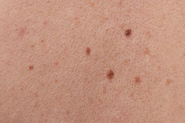 Fototapeta premium Woman with moles on her body, closeup