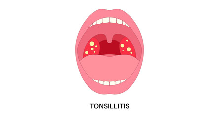 Tonsillitis Oral Desease