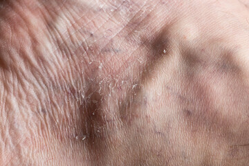 Varicosity or varicose medical close up image. Varicose veins on the male ankle with dry skin