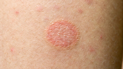 Closeup of ringworm skin infection on human arm