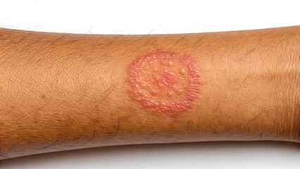 Ringworm rash on human skin arm closeup