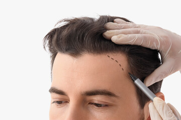 Doctor applying marking on man's head against white background, closeup. Hair transplantation...